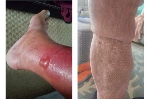 Be Well-Vibrio Illnesses