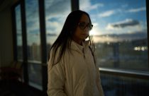 Autoimmune Diseases Lupus Photo Essay