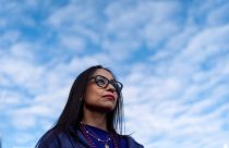 Autoimmune Diseases Lupus Photo Essay