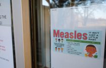 Measles