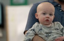 Measles-Babies