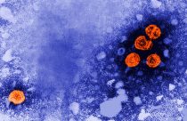 Hepatitis B