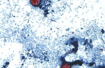 Cyclospora Outbreak