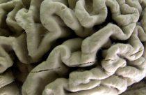 Alzheimers-Blood Test