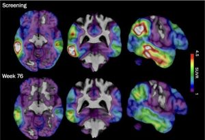 Alzheimers New Experimental Drugs