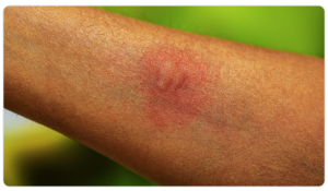 Mosquito Bite - CDC Image