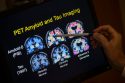 Be Well-Alzheimer's-Blood Tests