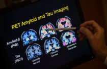 Be Well-Alzheimer's-Blood Tests