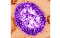 Measles Deaths