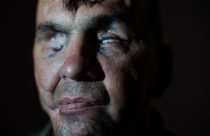 Russia Ukraine War Blind Soldier