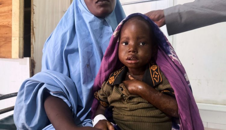 Somalia Malnutrition